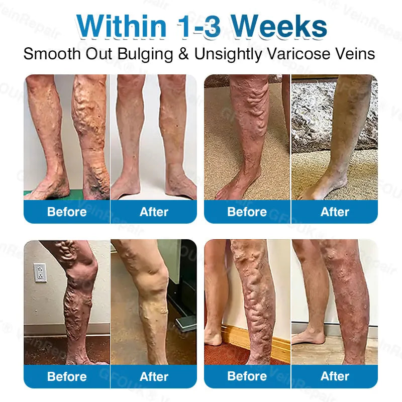 🇦🇺👨‍⚕️✅⭐GFOUK® VeinRepair Microneedle Patch Roll⚡Instant Relief, Long-Term Results
