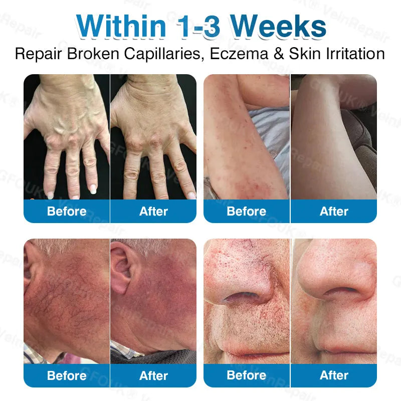 🇦🇺👨‍⚕️✅⭐GFOUK® VeinRepair Microneedle Patch Roll⚡Instant Relief, Long-Term Results