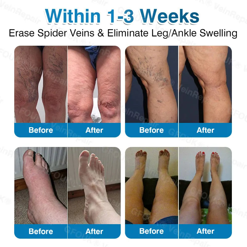 🇦🇺👨‍⚕️✅⭐GFOUK® VeinRepair Microneedle Patch Roll⚡Instant Relief, Long-Term Results